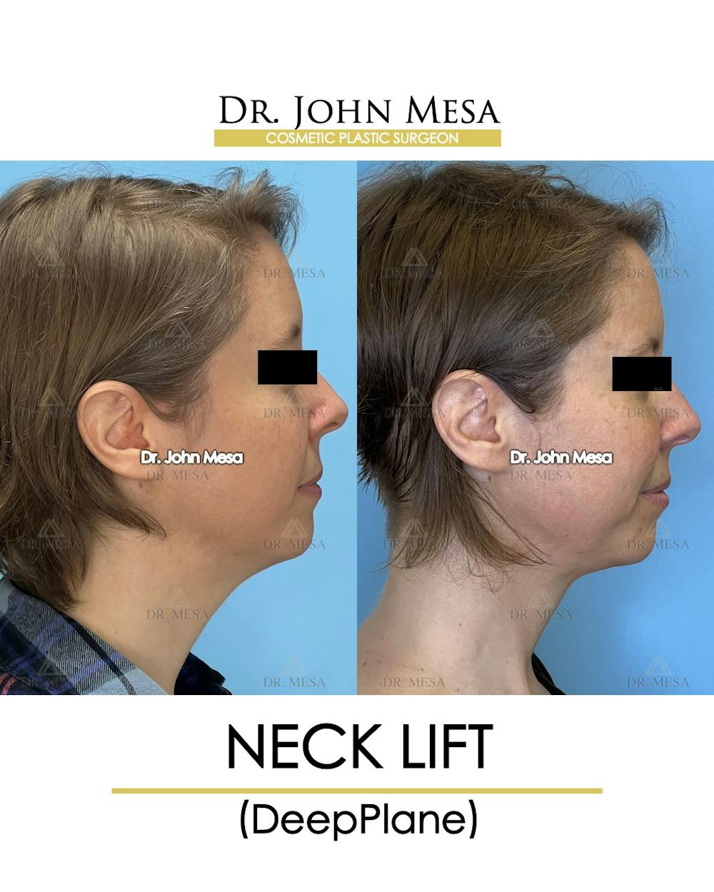 Neck Lift Before & After Gallery - Patient 148735375 - Image 3