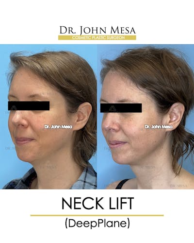 Neck Lift Before & After Gallery - Patient 148735375 - Image 4