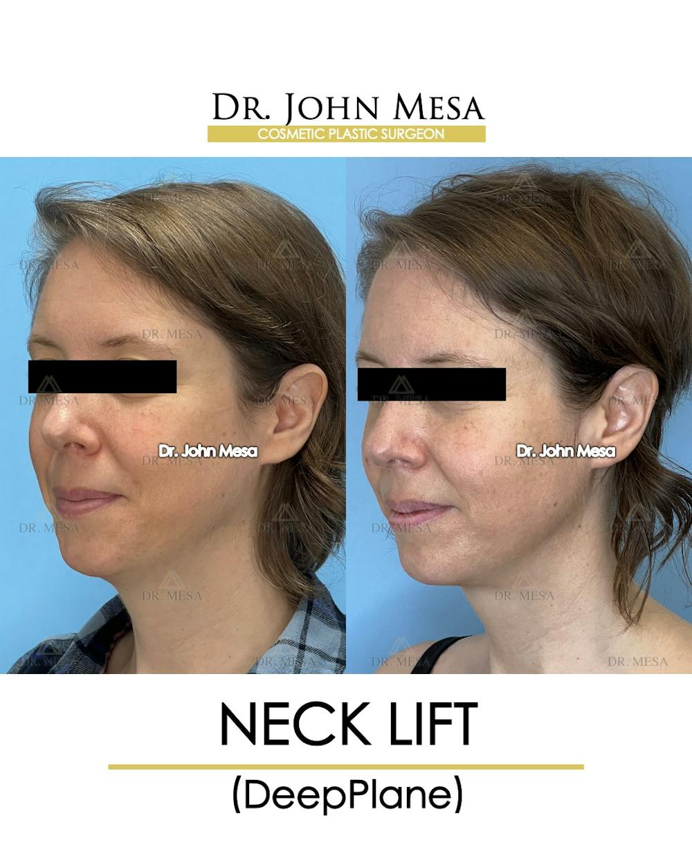 Neck Lift Before & After Gallery - Patient 148735375 - Image 4