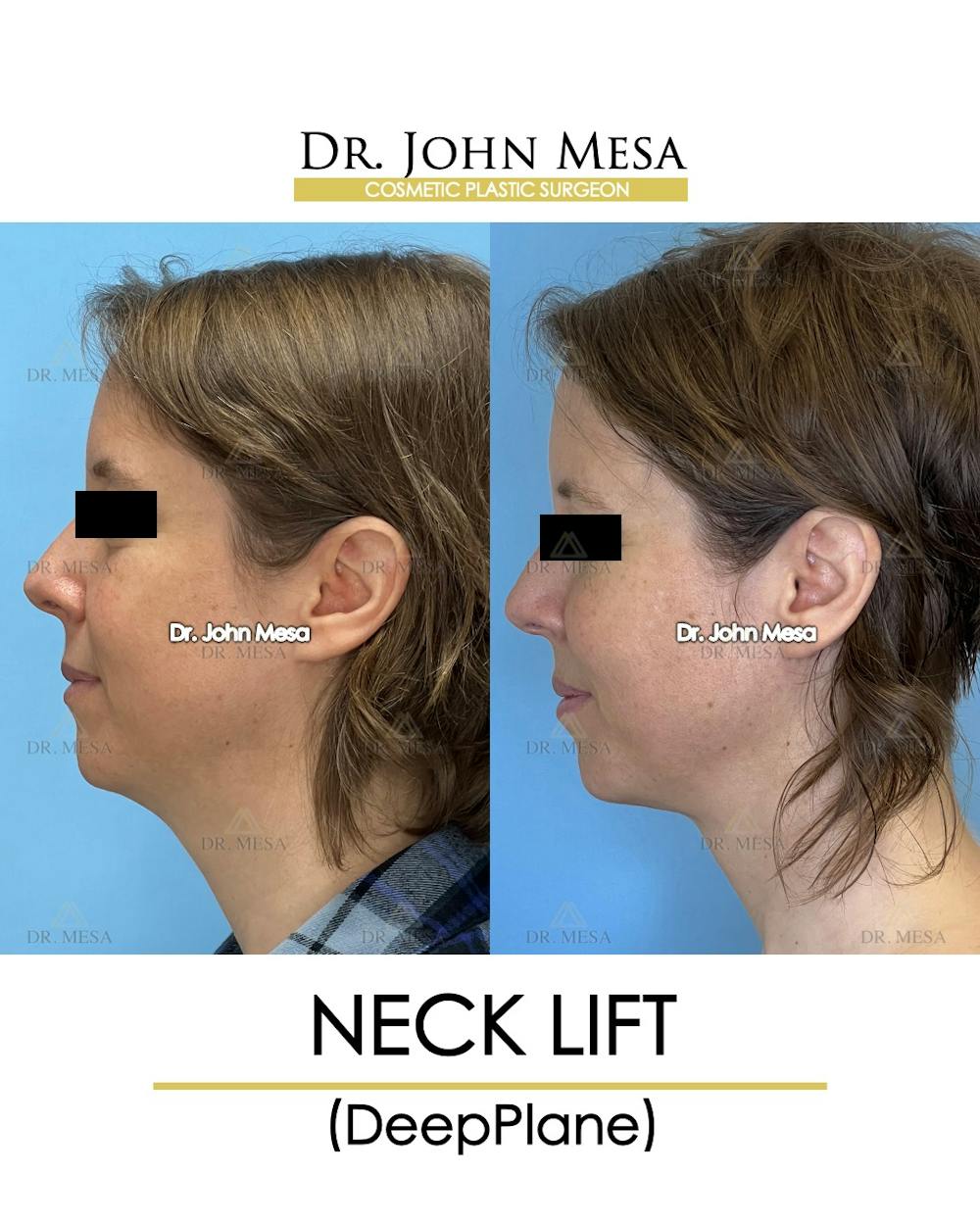 Neck Lift Before & After Gallery - Patient 148735375 - Image 5