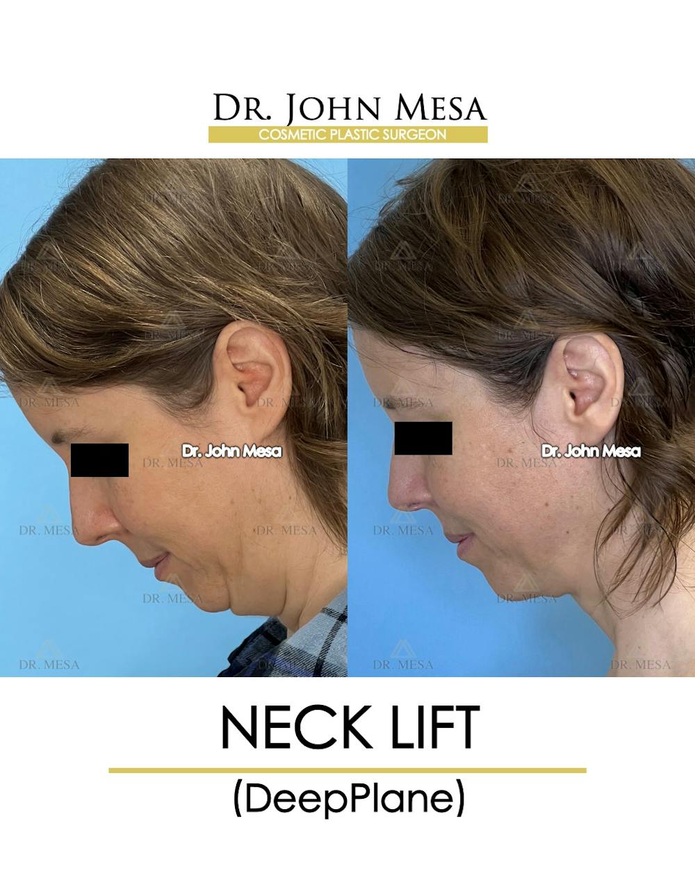 Neck Lift Before & After Gallery - Patient 148735375 - Image 6