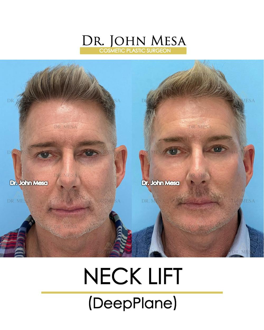 Neck Lift Before & After Gallery - Patient 148735380 - Image 1