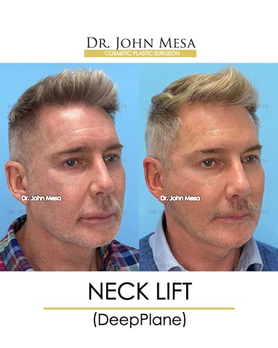 Neck Lift Before & After Gallery - Patient 148735380 - Image 2