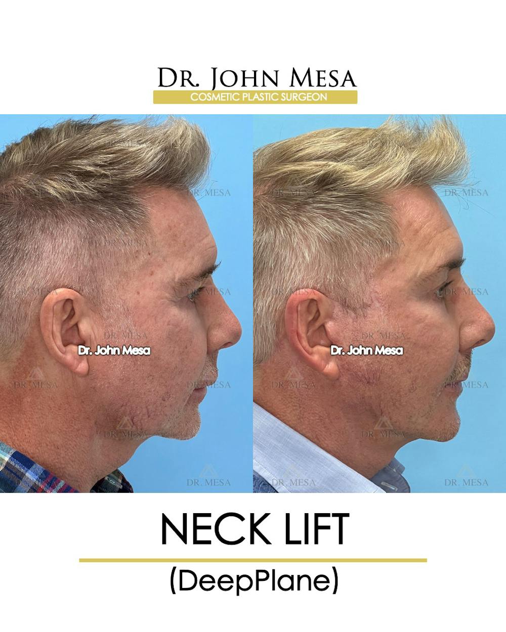Neck Lift Before & After Gallery - Patient 148735380 - Image 3