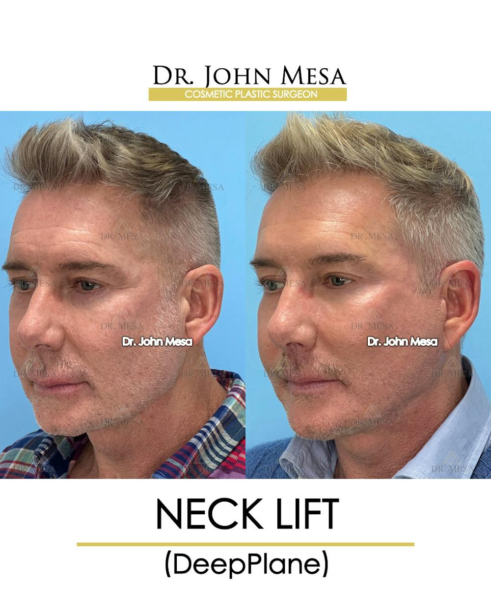 Neck Lift Before & After Gallery - Patient 148735380 - Image 4