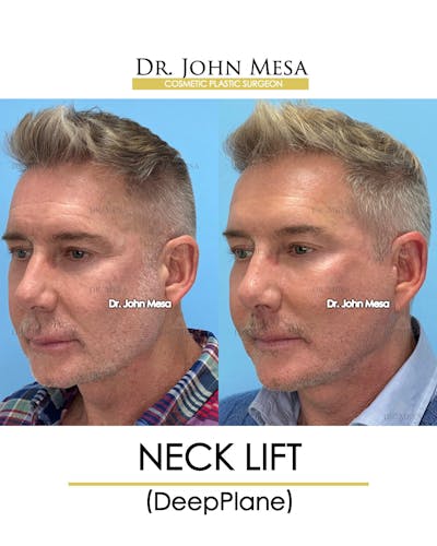 Neck Lift Before & After Gallery - Patient 148735380 - Image 4