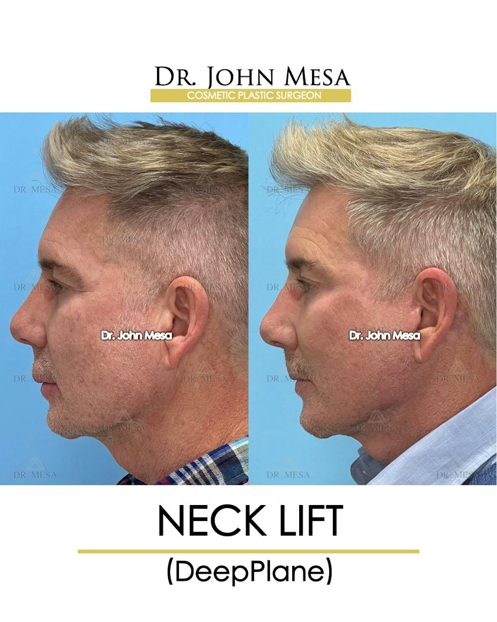 Neck Lift Before & After Gallery - Patient 148735380 - Image 5