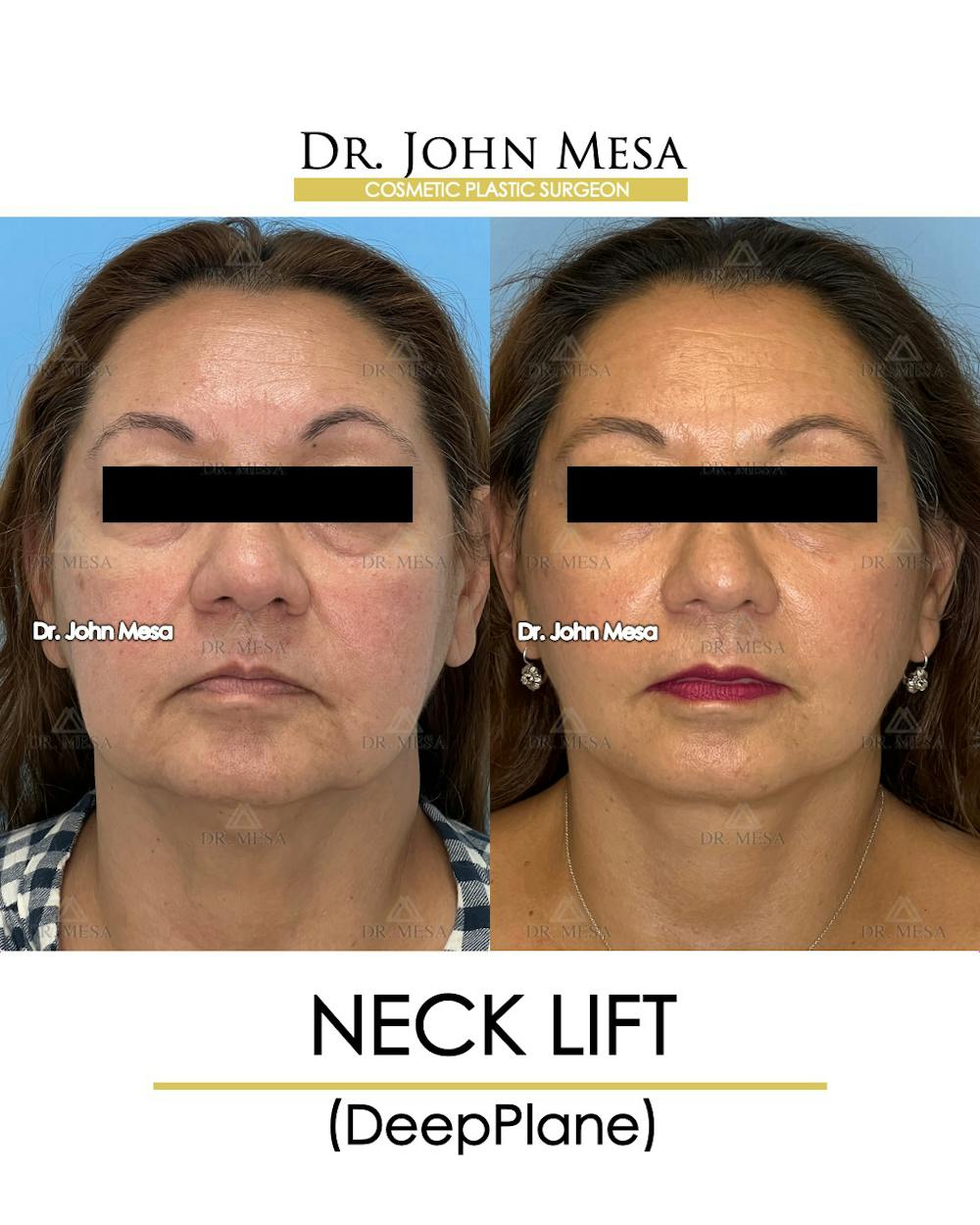 Neck Lift Before & After Gallery - Patient 148735376 - Image 1