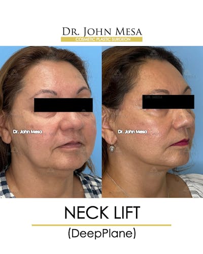 Neck Lift Before & After Gallery - Patient 148735376 - Image 2