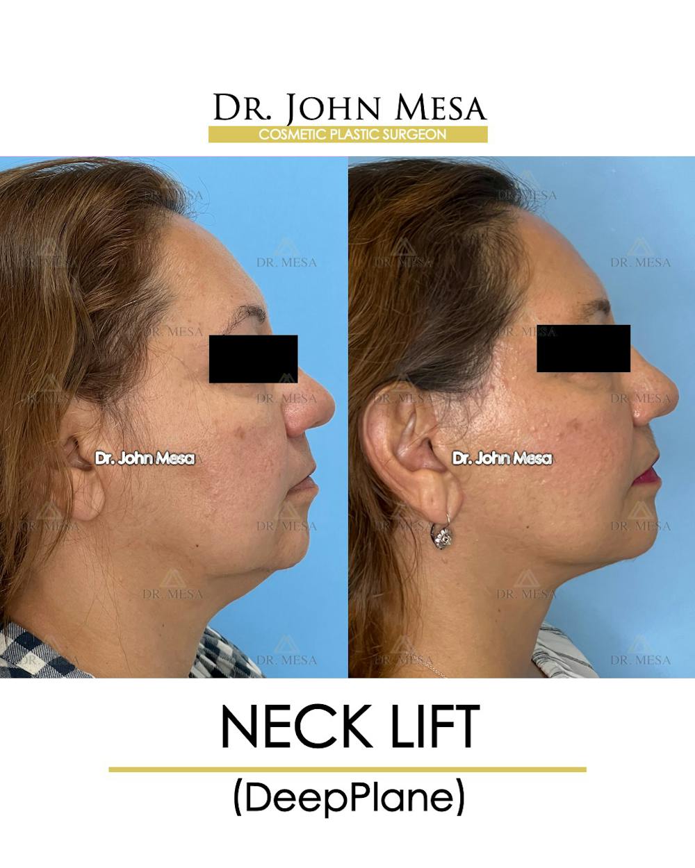 Neck Lift Before & After Gallery - Patient 148735376 - Image 3