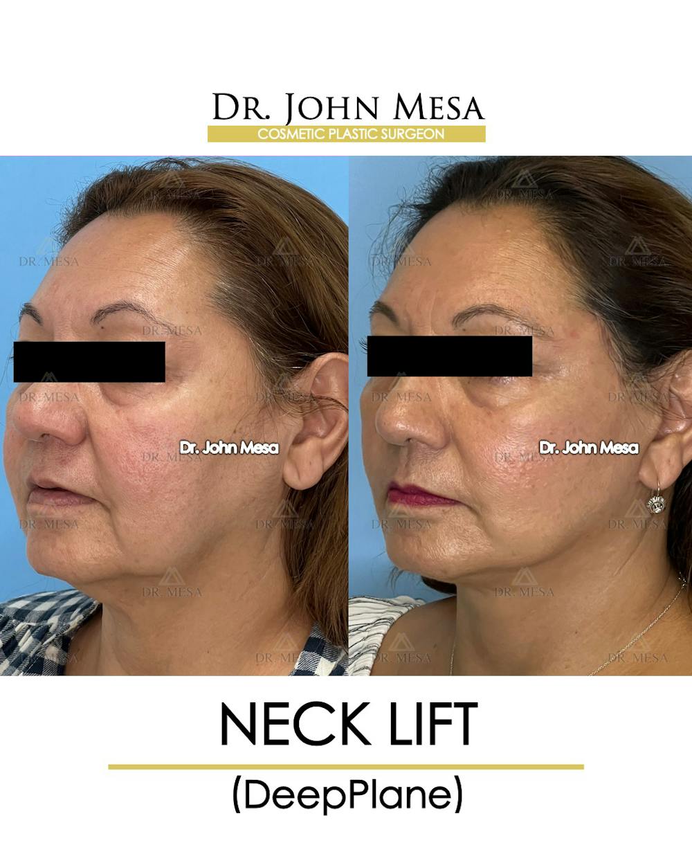 Neck Lift Before & After Gallery - Patient 148735376 - Image 4