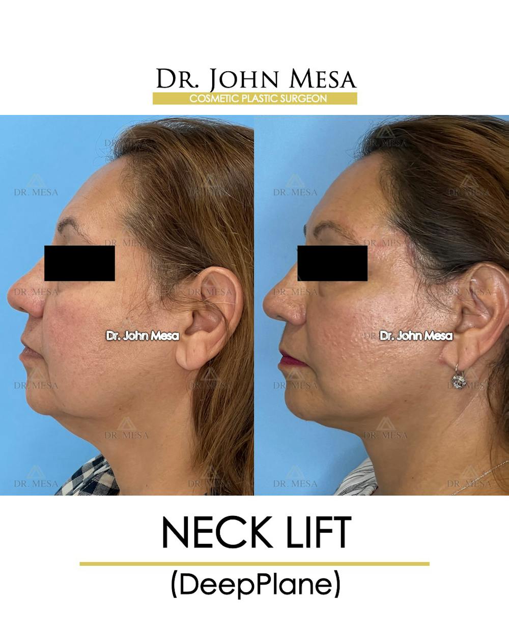 Neck Lift Before & After Gallery - Patient 148735376 - Image 5