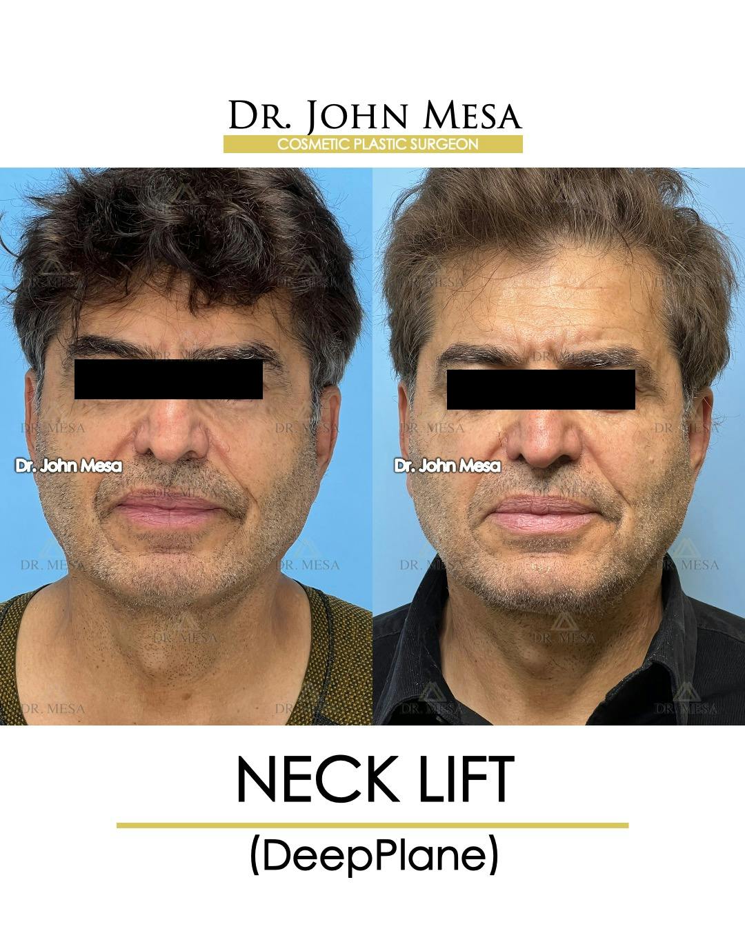 Neck Lift Before & After Gallery - Patient 148735381 - Image 1