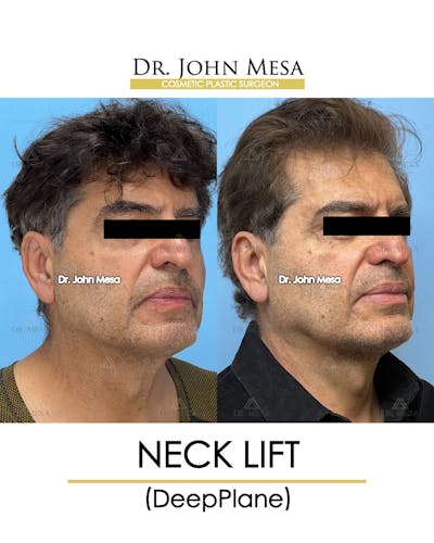 Neck Lift Before & After Gallery - Patient 148735381 - Image 2