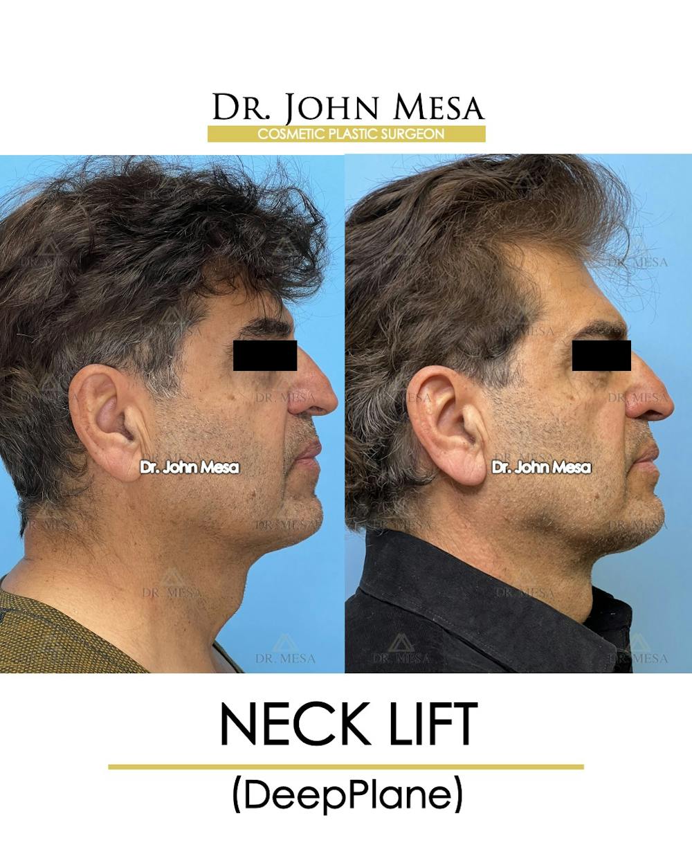 Neck Lift Before & After Gallery - Patient 148735381 - Image 3