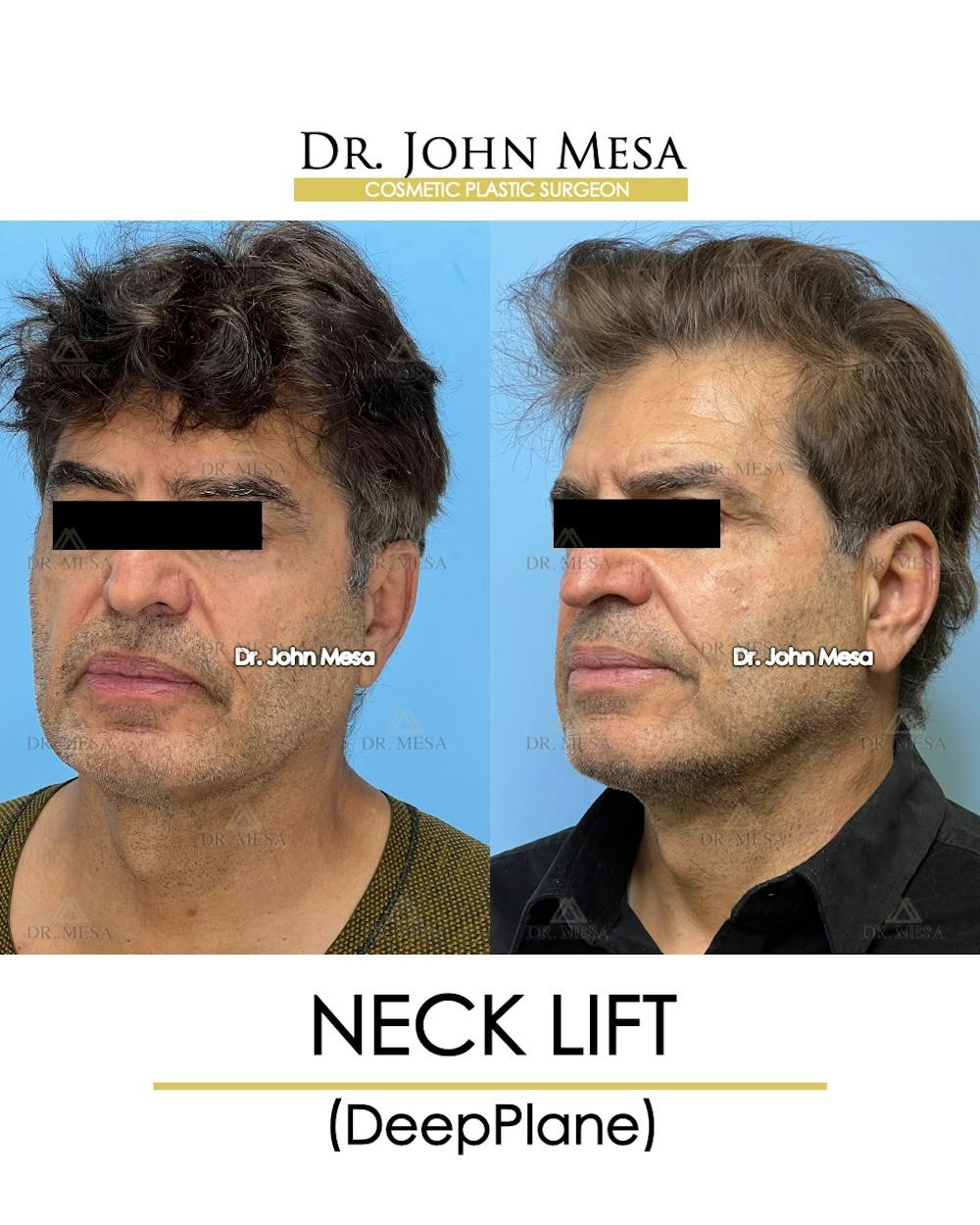 Neck Lift Before & After Gallery - Patient 148735381 - Image 4