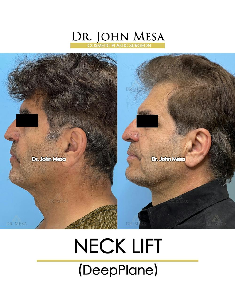 Neck Lift Before & After Gallery - Patient 148735381 - Image 5