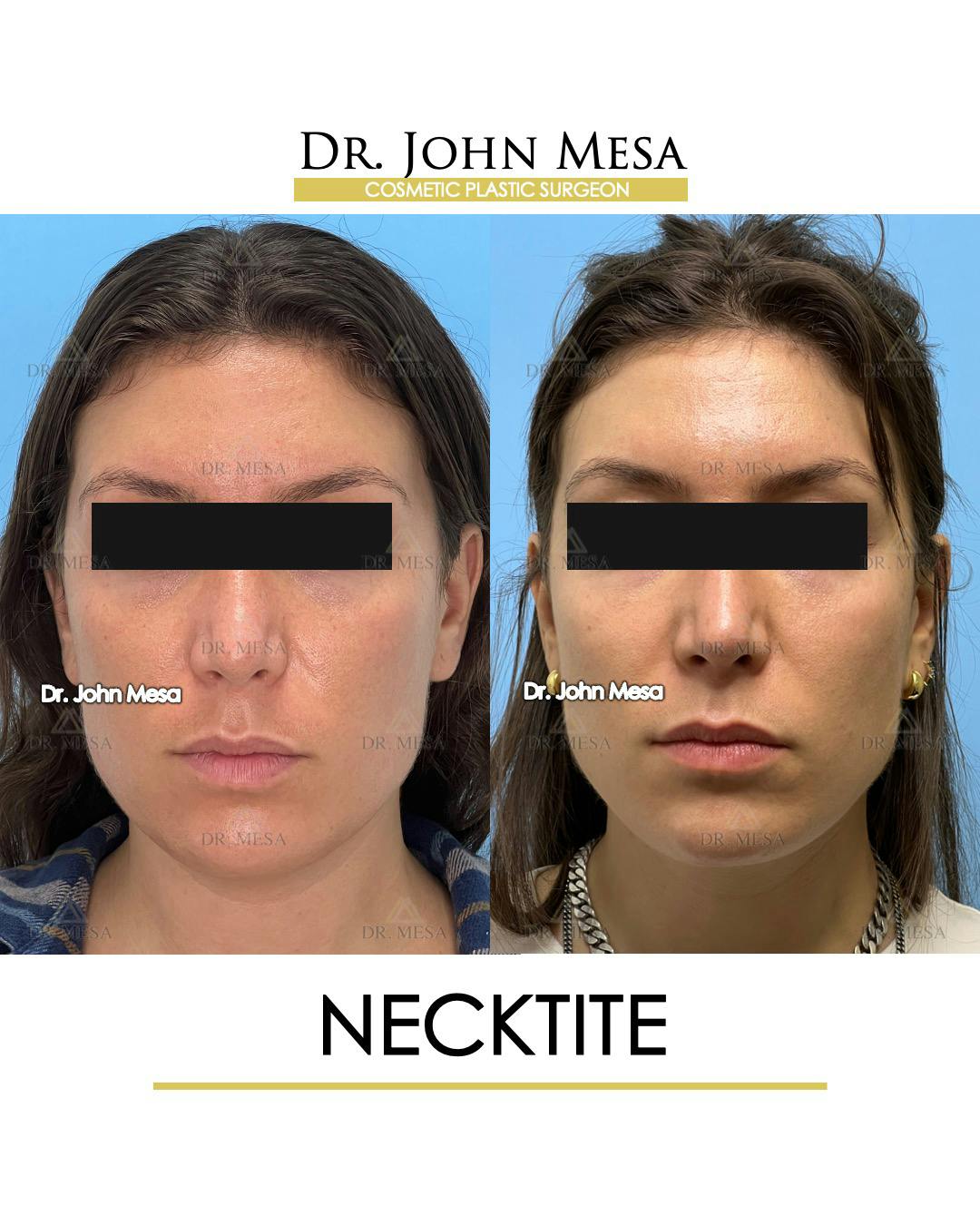 NeckTite Before & After Gallery - Patient 148735597 - Image 1