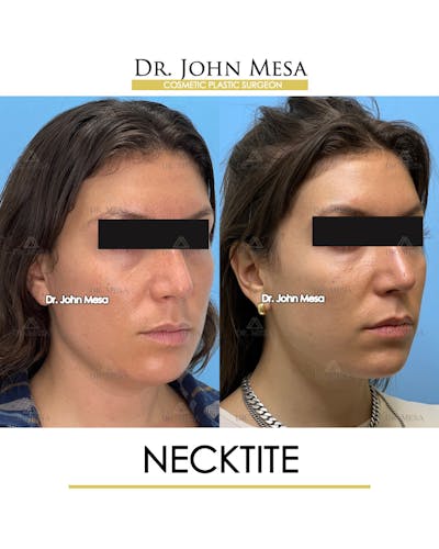 NeckTite Before & After Gallery - Patient 148735597 - Image 2