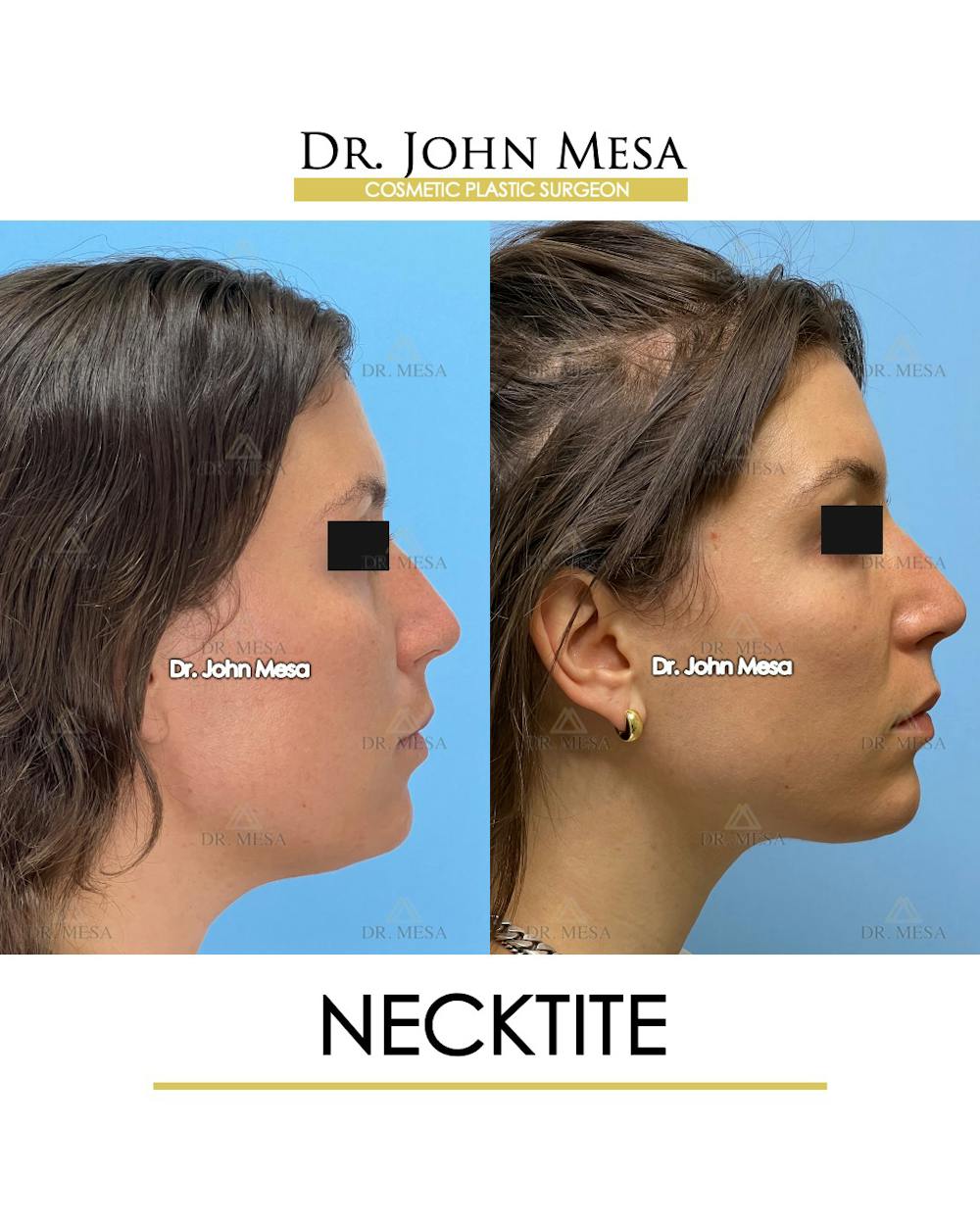 NeckTite Before & After Gallery - Patient 148735597 - Image 3