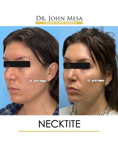 NeckTite Before & After Gallery - Patient 148735597 - Image 4