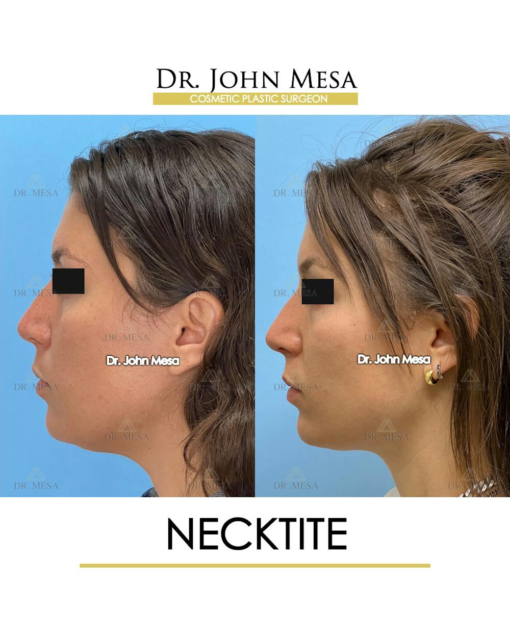 NeckTite Before & After Gallery - Patient 148735597 - Image 5