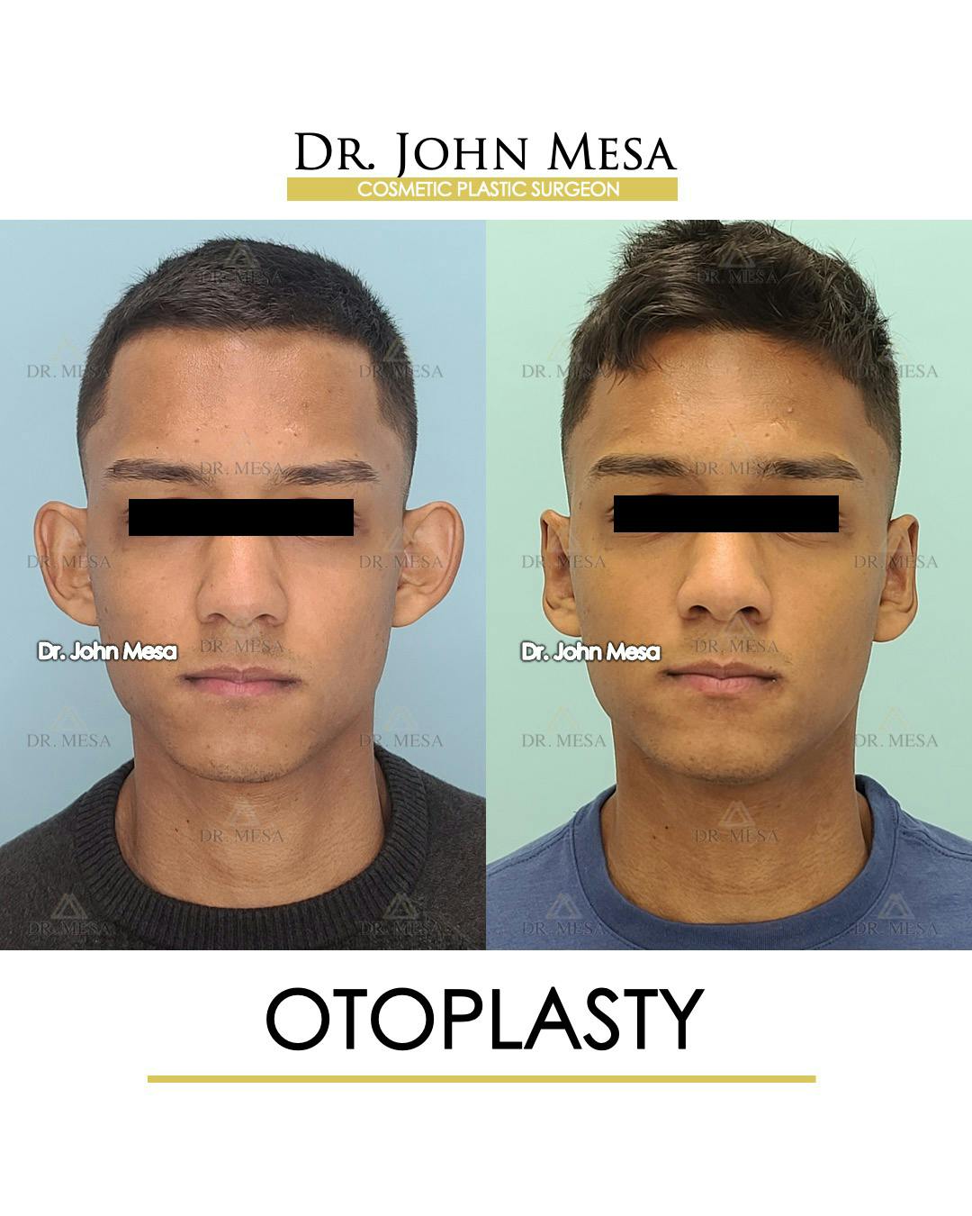 Otoplasty Before & After Gallery - Patient 148736018 - Image 1