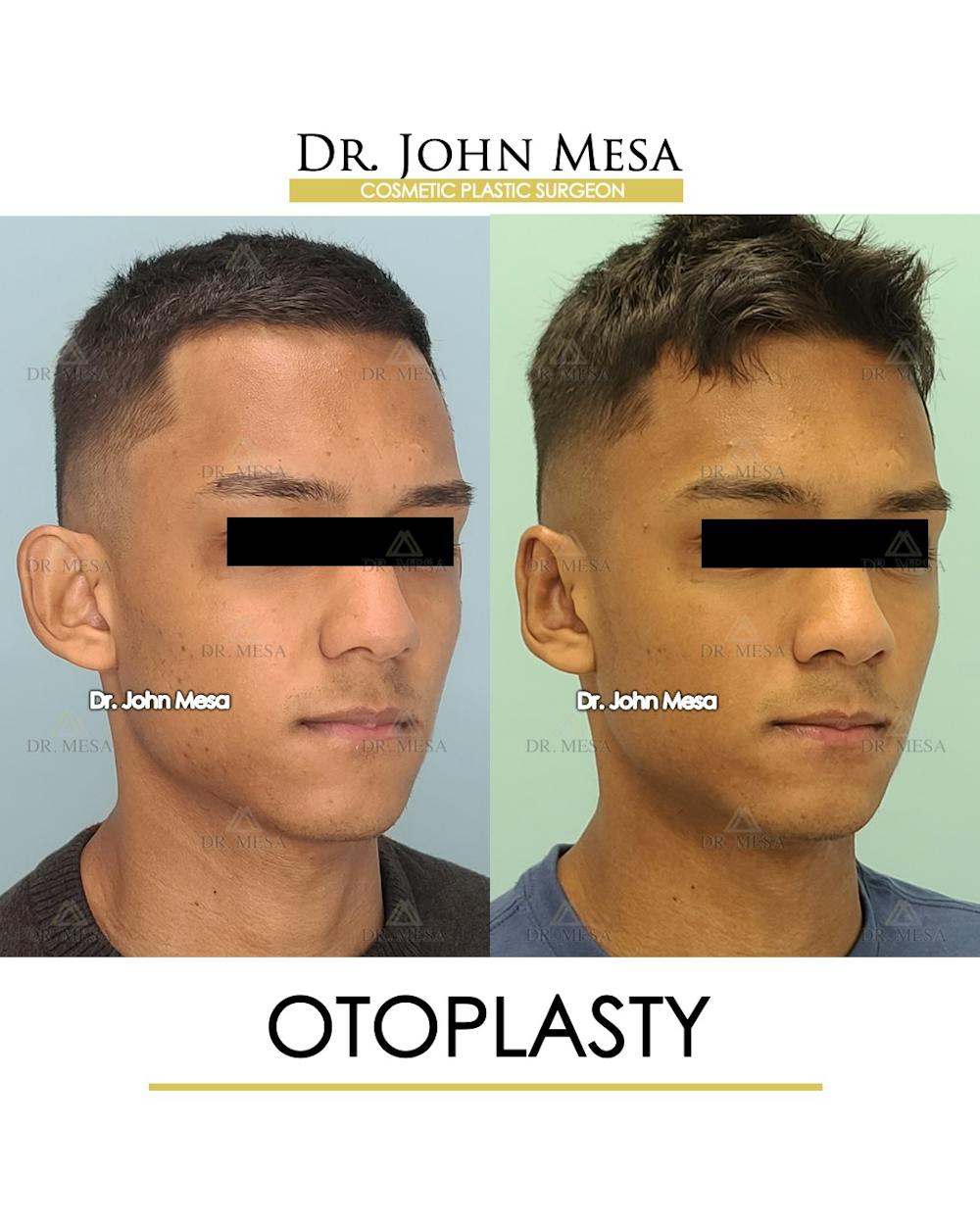 Otoplasty Before & After Gallery - Patient 148736018 - Image 2