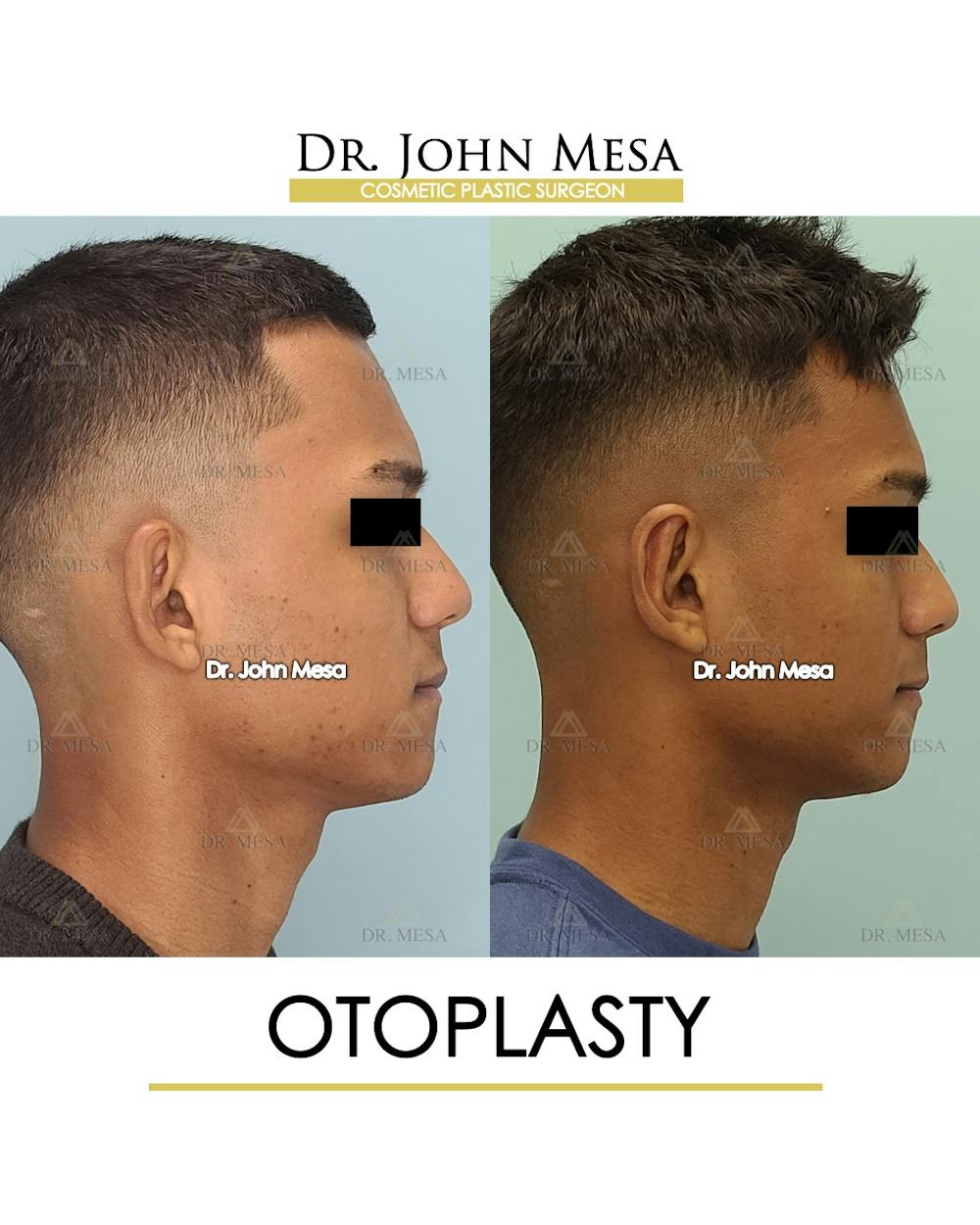 Otoplasty Before & After Gallery - Patient 148736018 - Image 3
