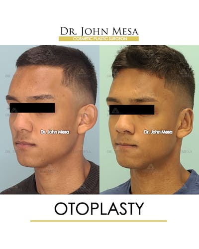 Otoplasty Before & After Gallery - Patient 148736018 - Image 4