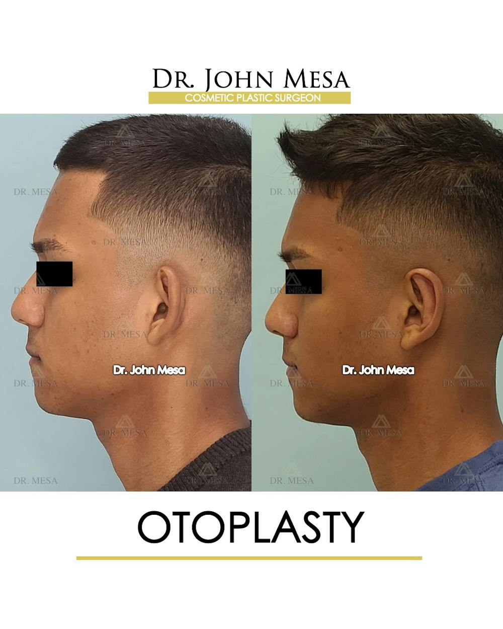 Otoplasty Before & After Gallery - Patient 148736018 - Image 5