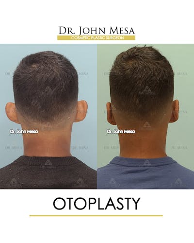 Otoplasty Before & After Gallery - Patient 148736018 - Image 6