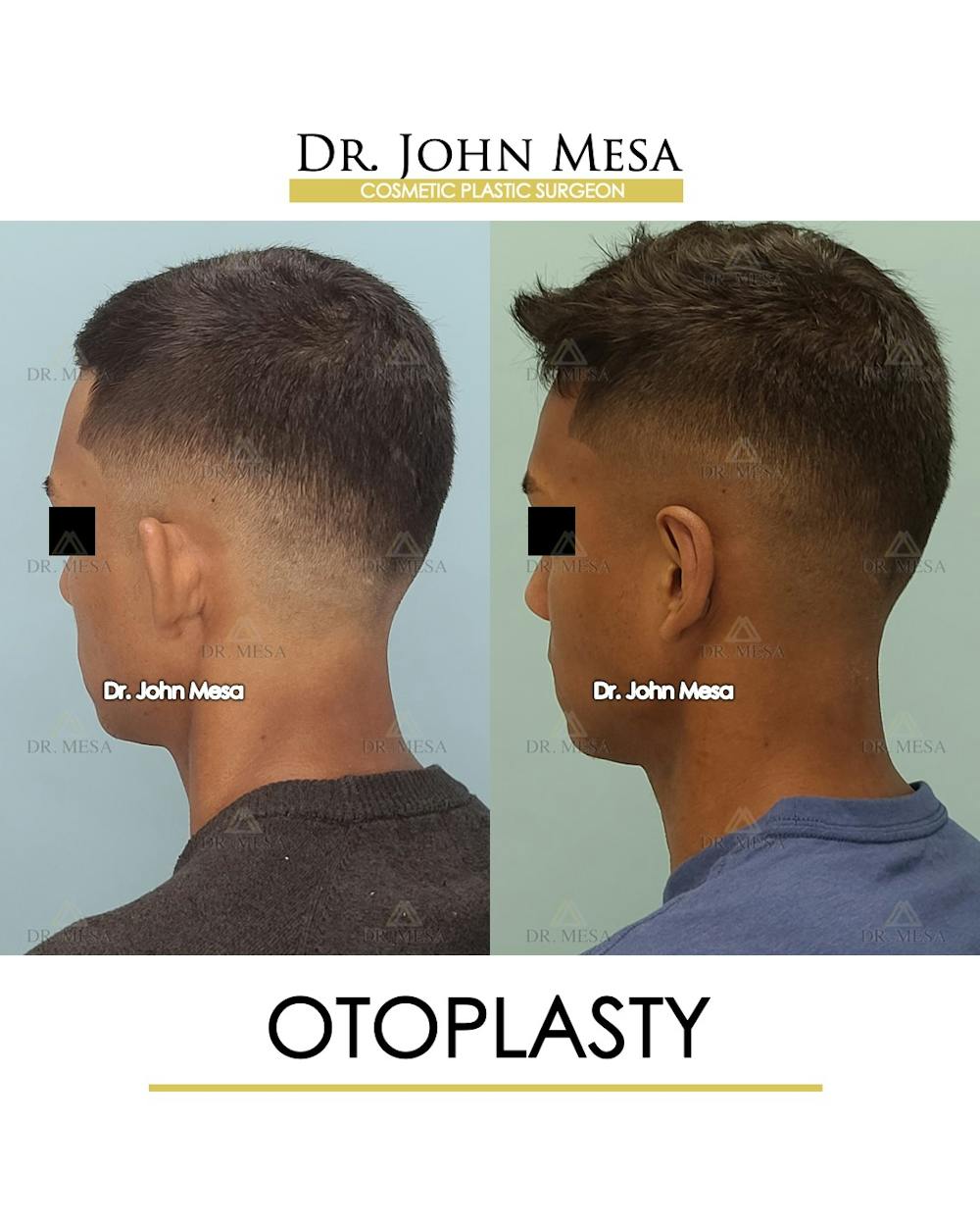 Otoplasty Before & After Gallery - Patient 148736018 - Image 7
