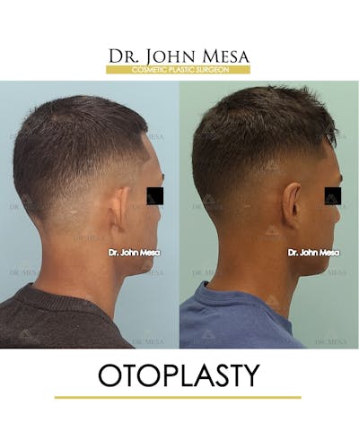 Otoplasty Before & After Gallery - Patient 148736018 - Image 8