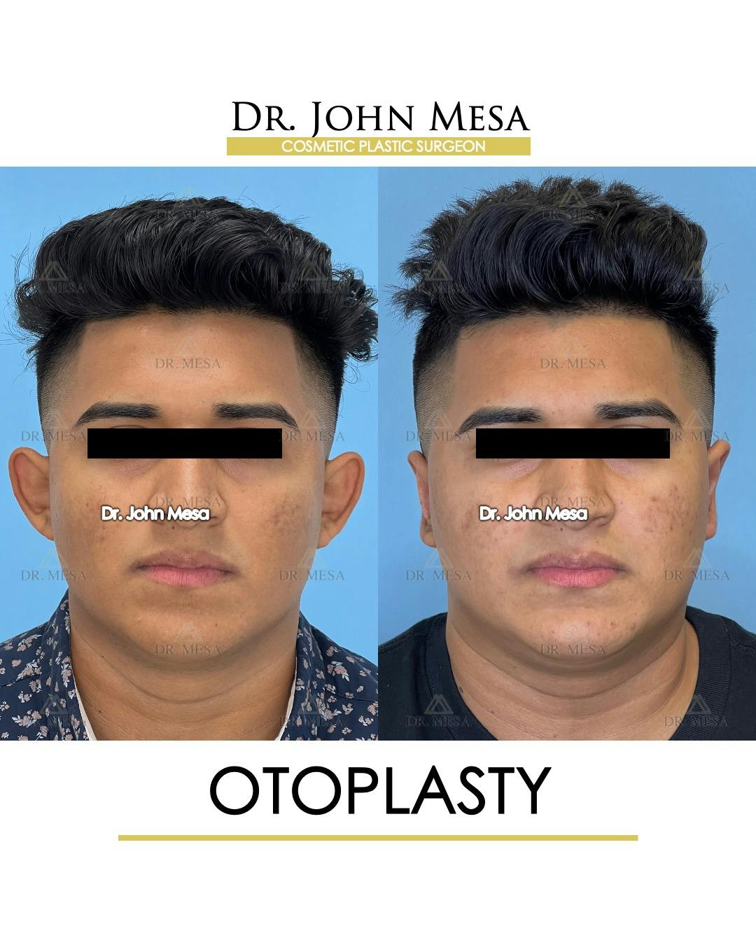 Otoplasty Before & After Gallery - Patient 148736019 - Image 1