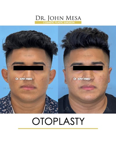 Otoplasty Before & After Gallery - Patient 148736019 - Image 1