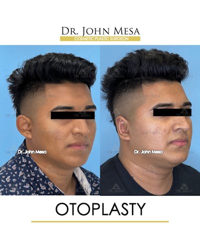 Otoplasty Before & After Gallery - Patient 148736019 - Image 2