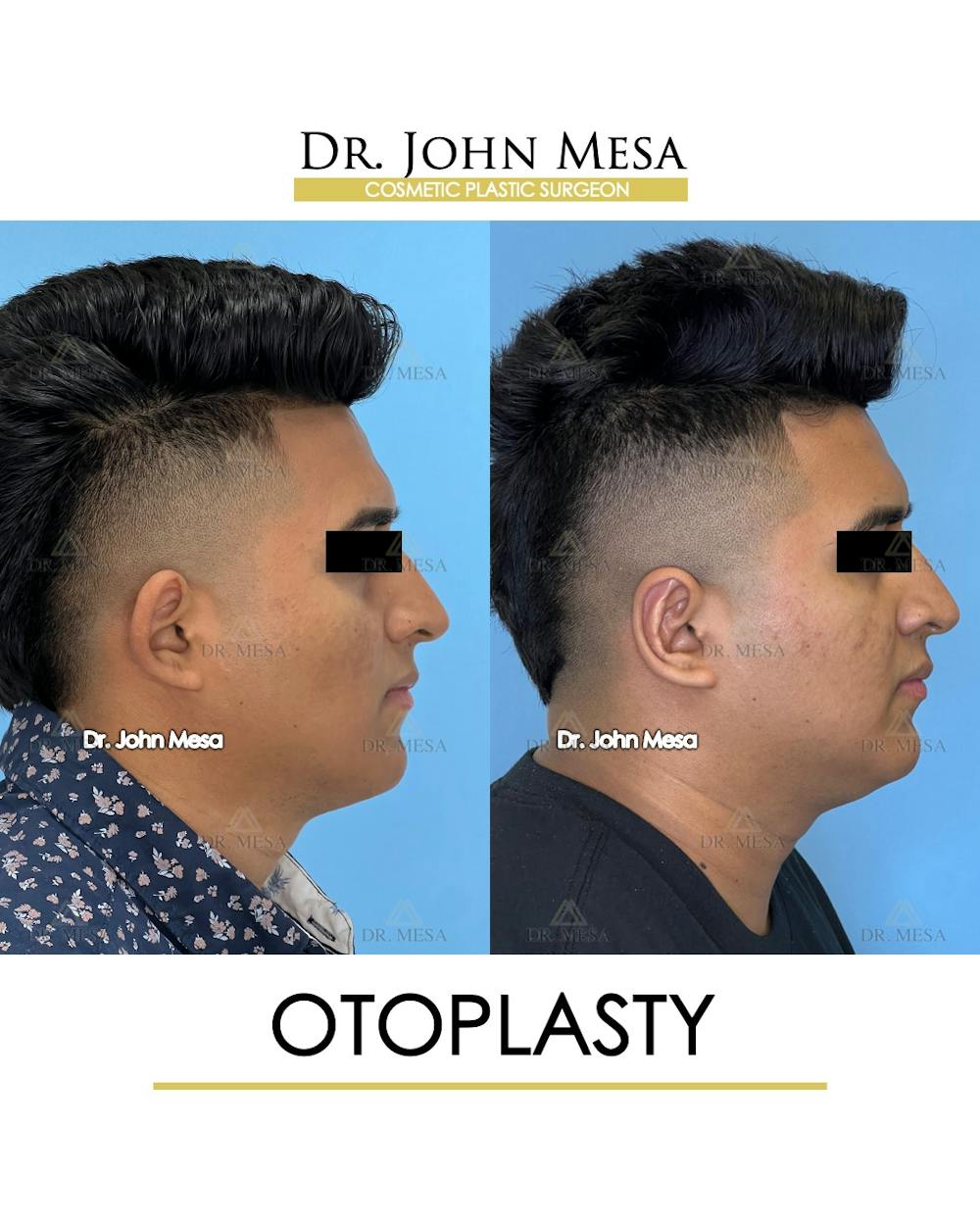 Otoplasty Before & After Gallery - Patient 148736019 - Image 3