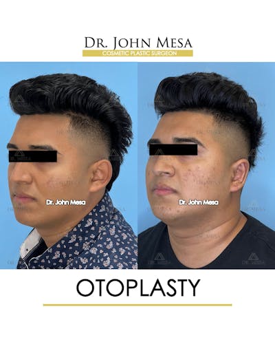 Otoplasty Before & After Gallery - Patient 148736019 - Image 4