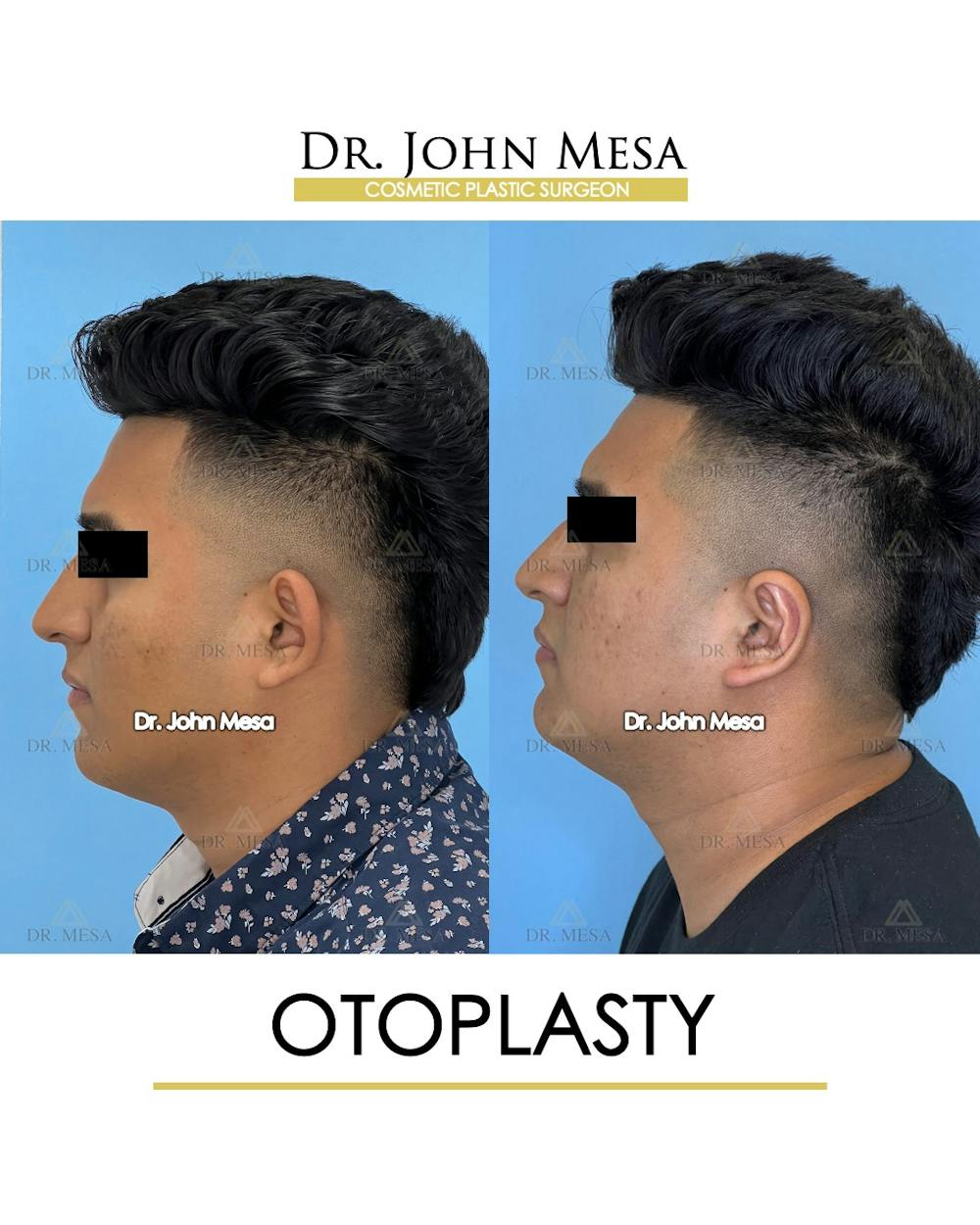 Otoplasty Before & After Gallery - Patient 148736019 - Image 5