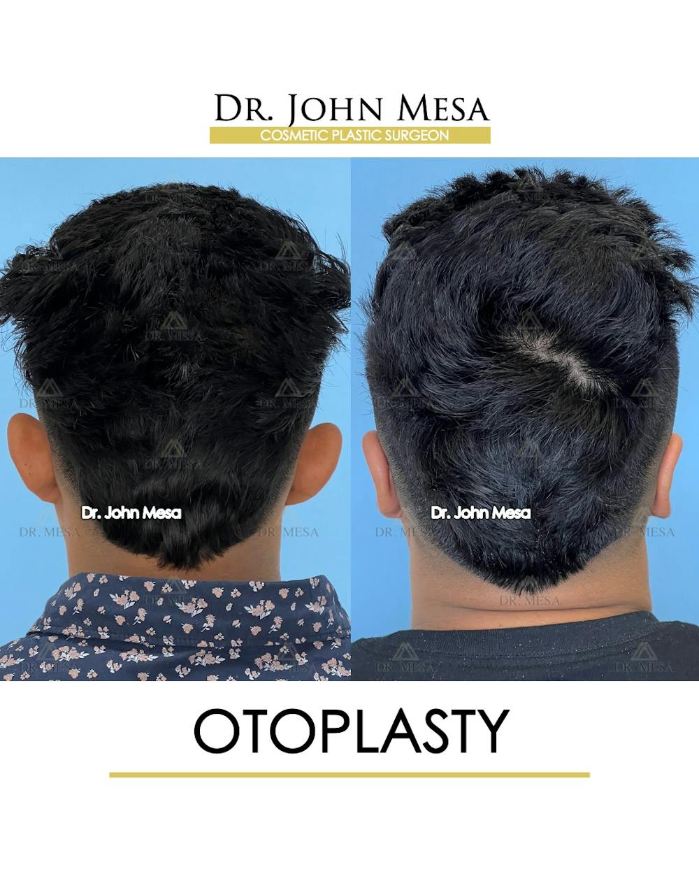 Otoplasty Before & After Gallery - Patient 148736019 - Image 6
