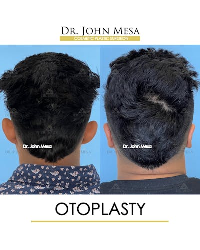 Otoplasty Before & After Gallery - Patient 148736019 - Image 6