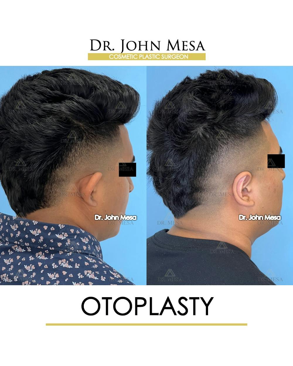 Otoplasty Before & After Gallery - Patient 148736019 - Image 7