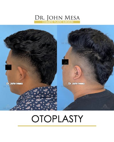 Otoplasty Before & After Gallery - Patient 148736019 - Image 8