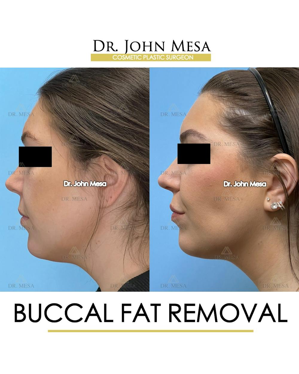 Buccal Fat Pad Removal Before & After Gallery - Patient 149097945 - Image 5
