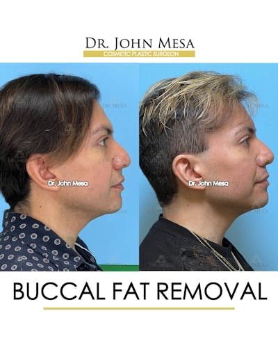 Buccal Fat Pad Removal for Men Before & After Gallery - Patient 149097952 - Image 4