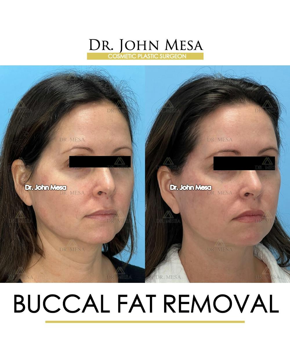 Buccal Fat Pad Removal Before & After Gallery - Patient 149097944 - Image 2