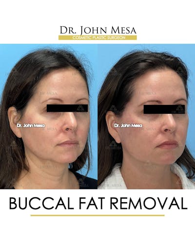 Buccal Fat Pad Removal Before & After Gallery - Patient 149097944 - Image 2