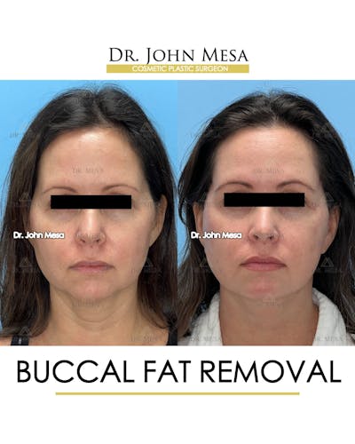 Buccal Fat Pad Removal Before & After Gallery - Patient 149097944 - Image 1
