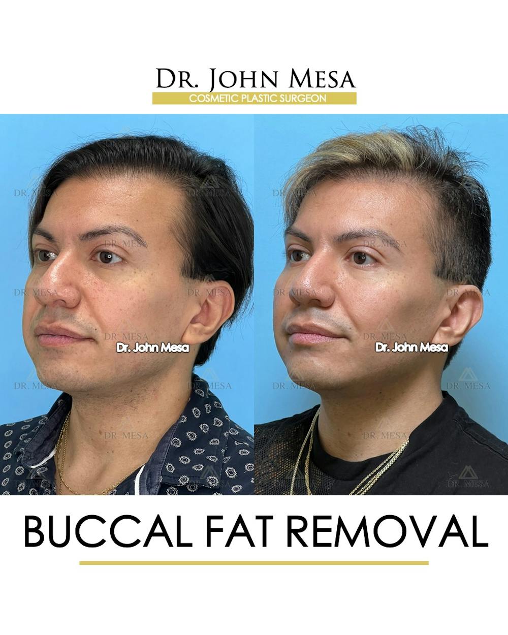 Buccal Fat Pad Removal for Men Before & After Gallery - Patient 149097952 - Image 3